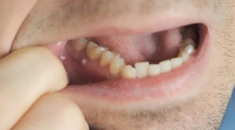 "Espinha" na gengiva deixando gosto ruim na boca