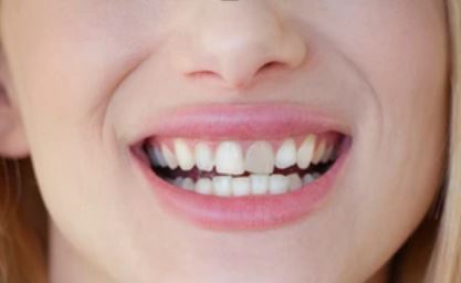 Dente com aspecto escurecido