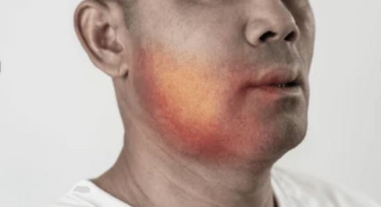 Inchaço ao redor do dente ou no rosto